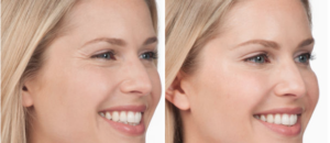 Botox Cosmetics Before & After